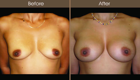 20123008102300_breastaug_2_front